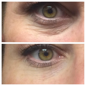 Revitalizing Eye Treatment - Upgrade